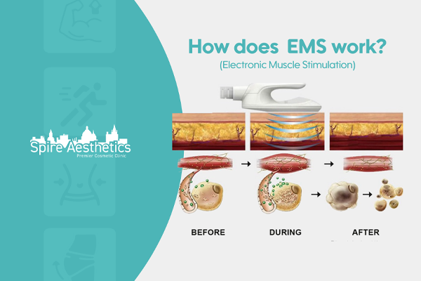 EMS treatment for post pregnancy weight loss treatment Tewkesbury