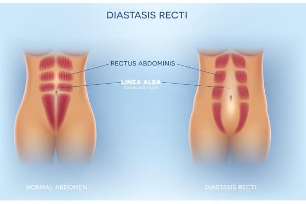 How Does Non-Surgical Treatment Help With Loose Skin, Weak Abdominal Muscles and Post-Pregnancy Changes Tewkesbury?