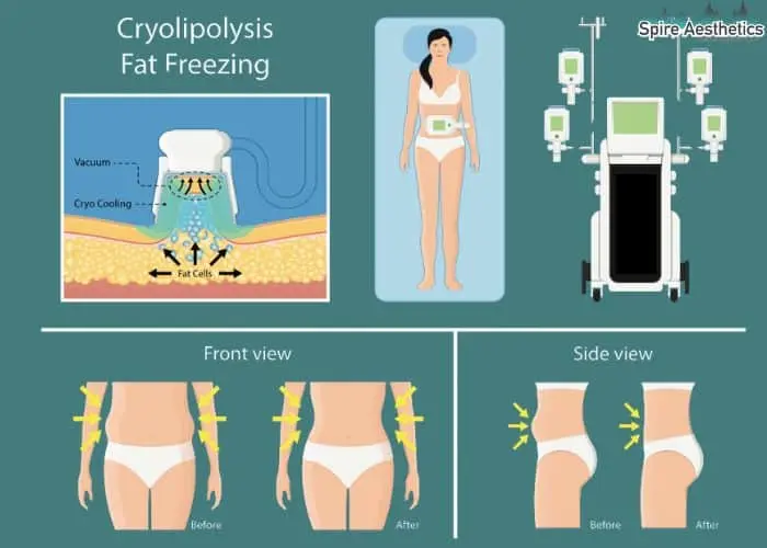 Fat freezing treatment Tewkesbury benefits for competitions to remove stubborn fat deposits.