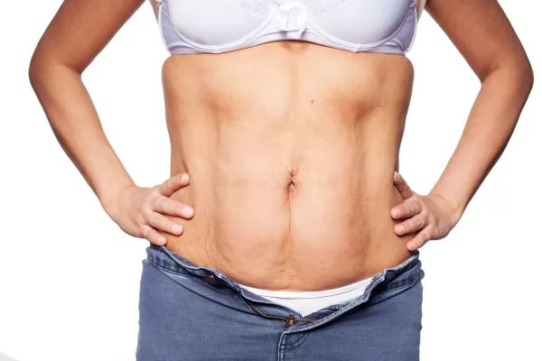 sagging skin on woman's stomach after weight loss injections Tewkesbury