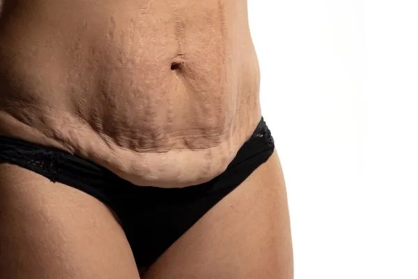 Image of womans stomach after weight loss injections Tewkesbury showing saggy skin