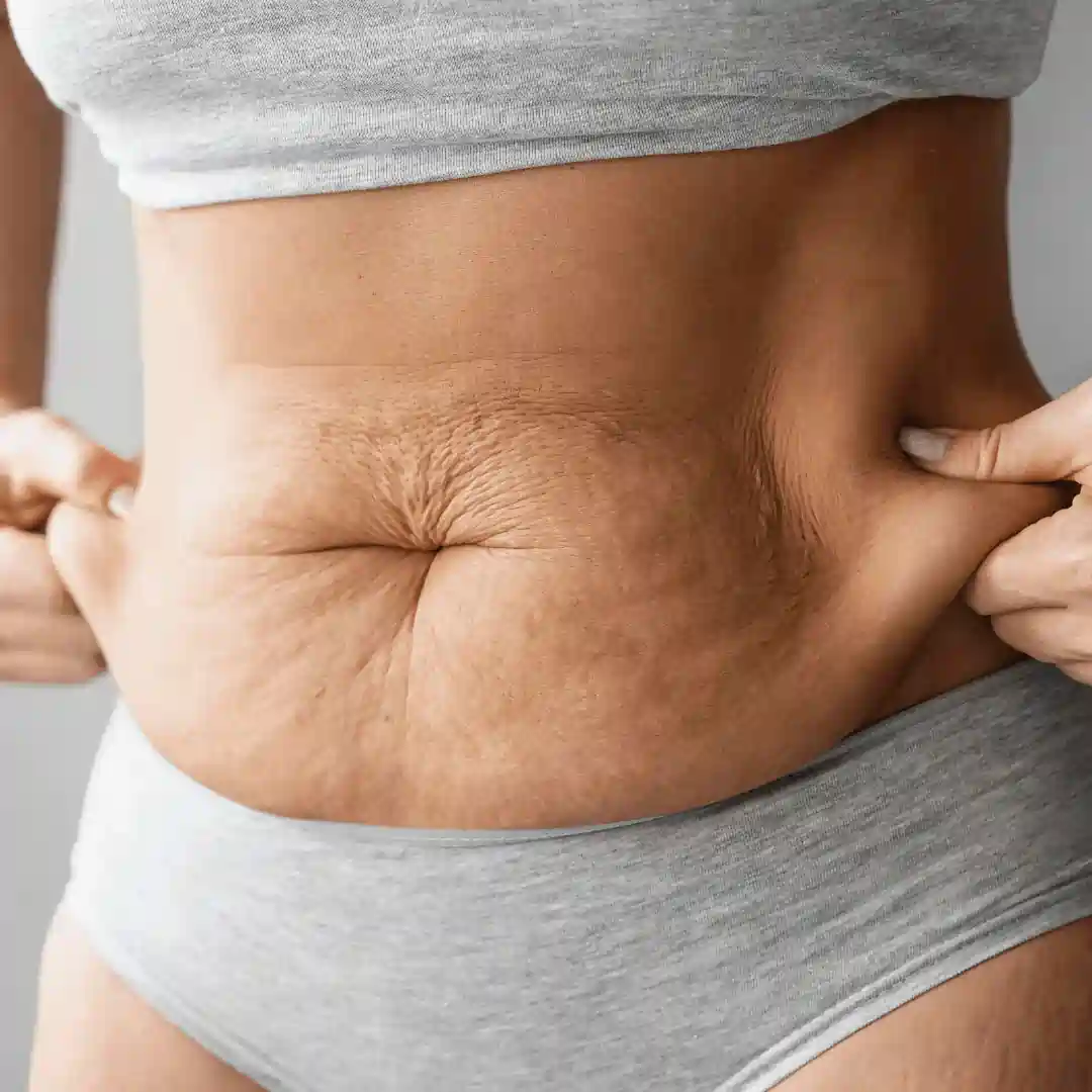 Is It Normal to Have Loose Skin After Pregnancy Tewkesbury?