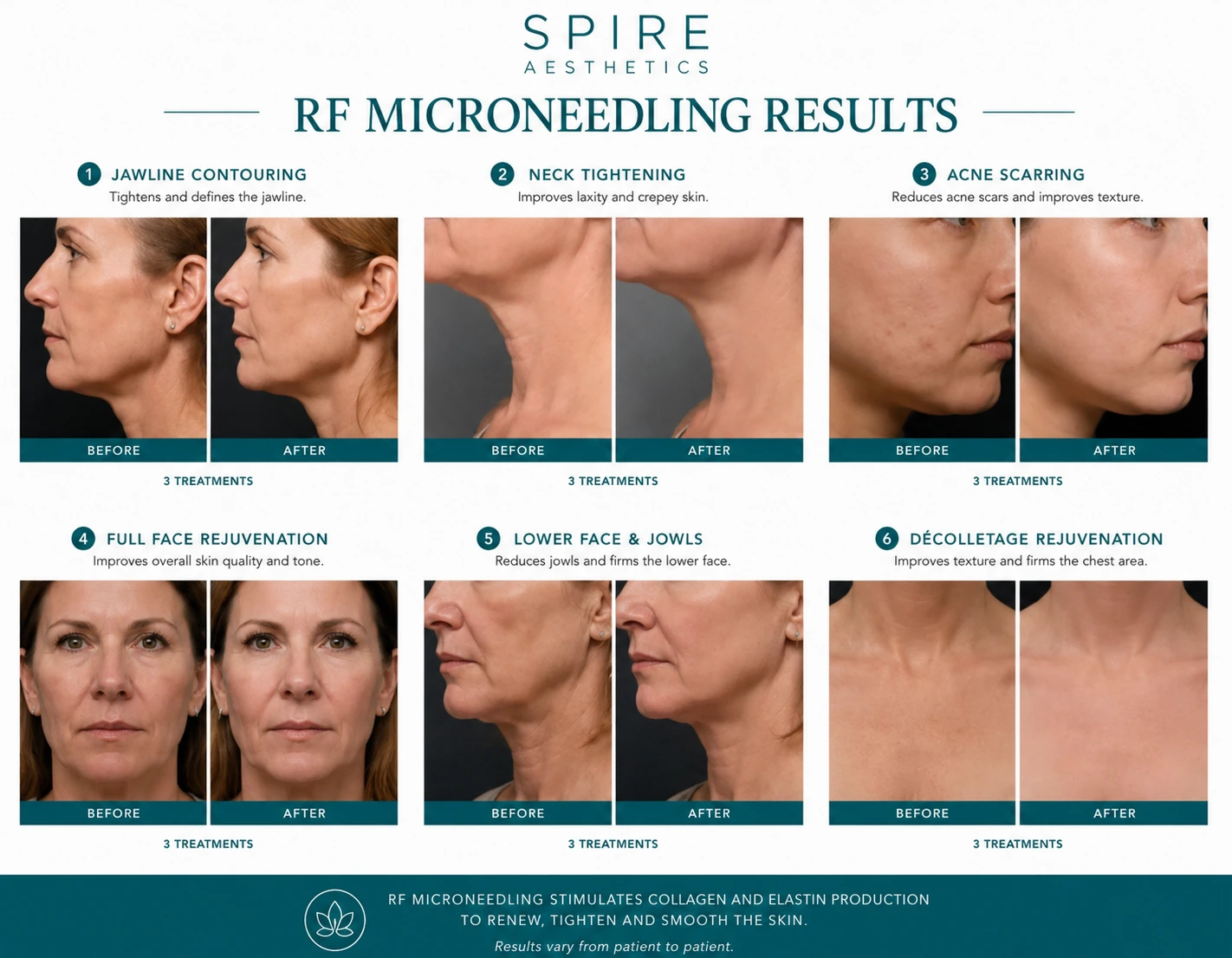 RF Microneedling Skin tightening Tewkesbury results