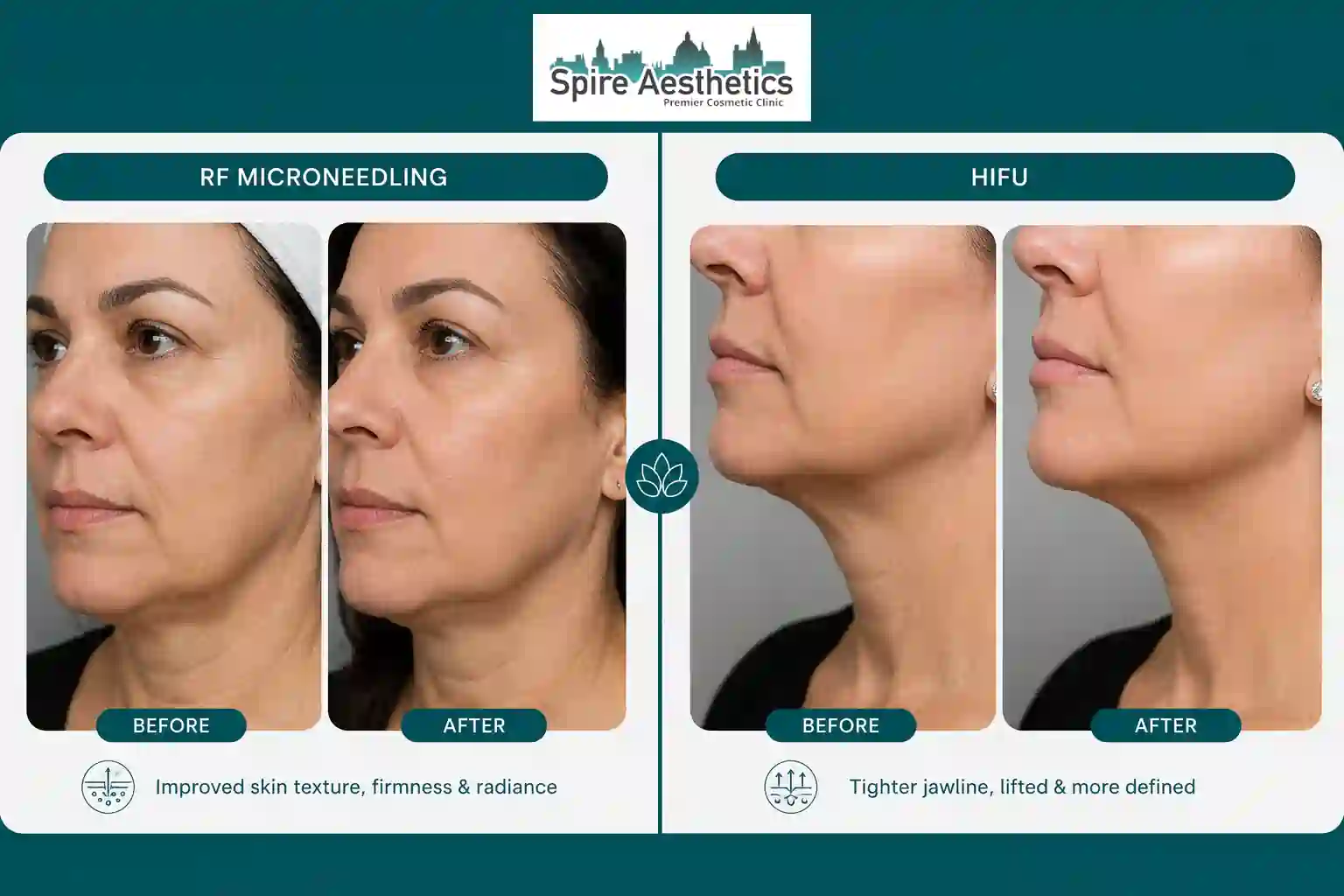 Can RF Microneedling and HIFU Be Combined Tewkesbury?