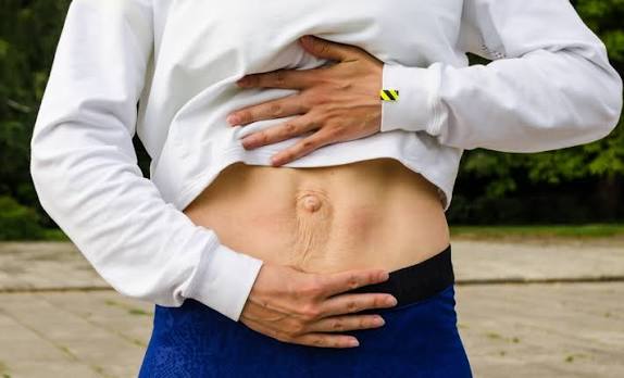 When Could Diastasis Recti Be the Missing Piece of the Puzzle Tewkesbury?