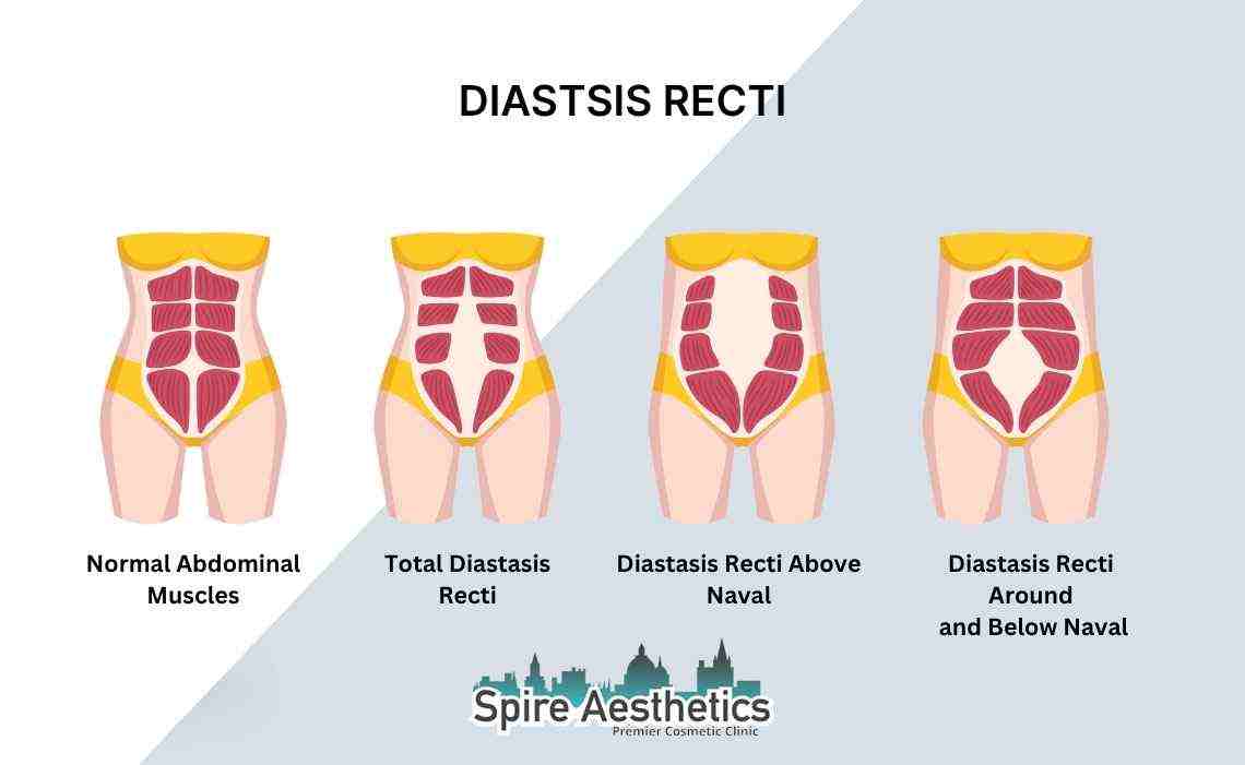Is Non-Surgical Diastasis Recti Treatment Right for You? Common Concerns Answered Tewkesbury